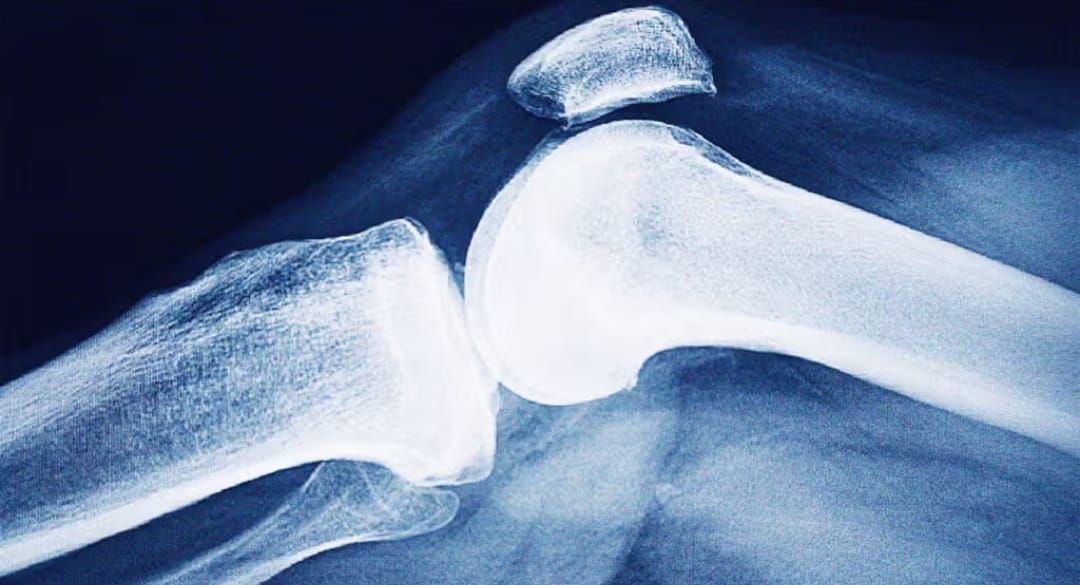 Osteoporosis: The Other Silent Burden
