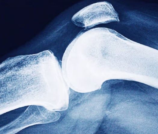 Osteoporosis: The Other Silent Burden