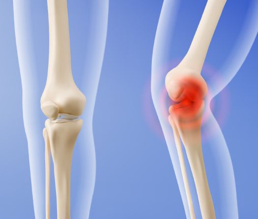 Smart Cartilage: The New Frontier Against Arthritis?